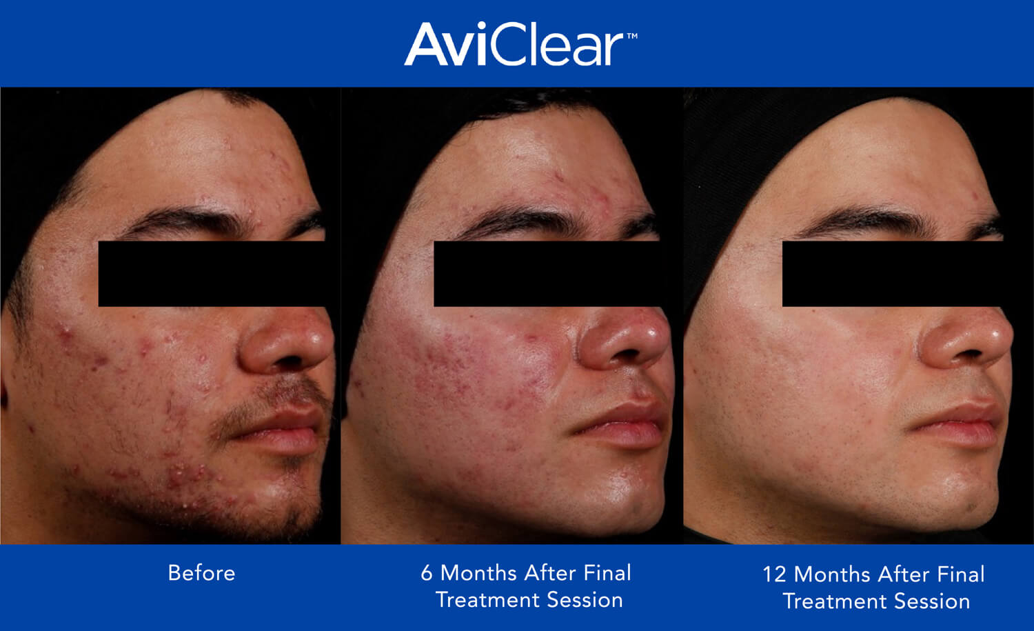 AviClear before and after photos showing remarkable acne improvement after 12 months.