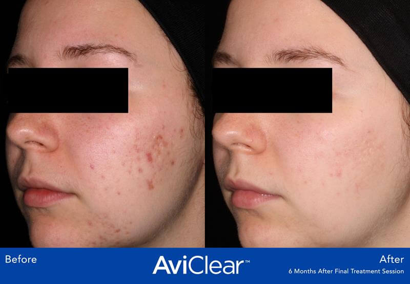 Face skin acne before and after AviClear treatment.