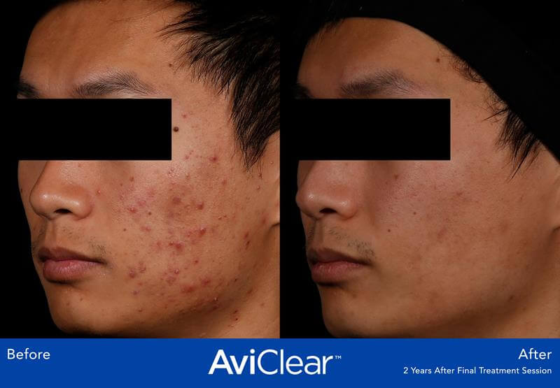 AviClear acne treatment.