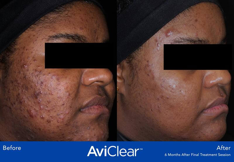Patient with clear skin after AviClear treatment.