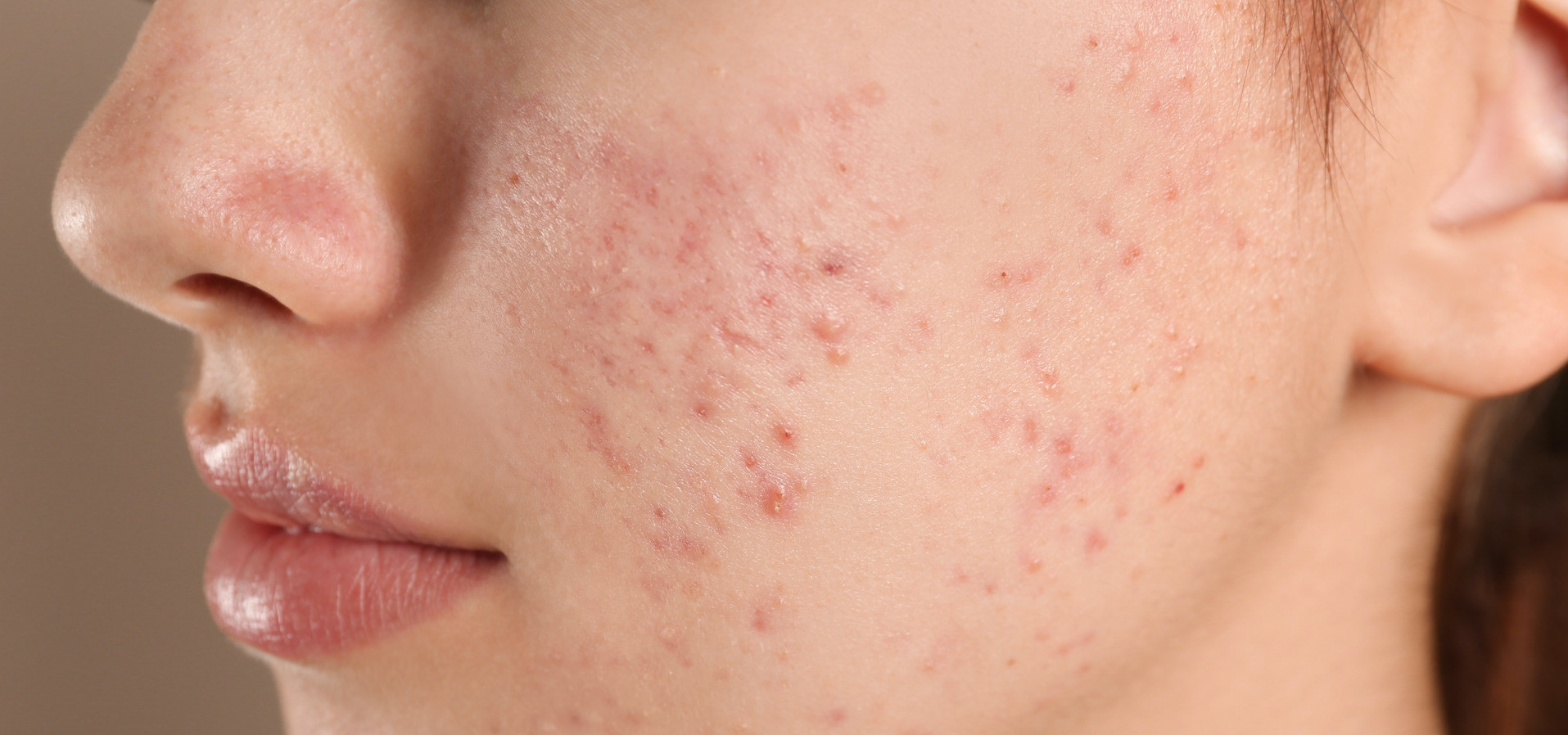 Acne